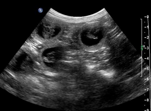 Pregnancy ultrasound image